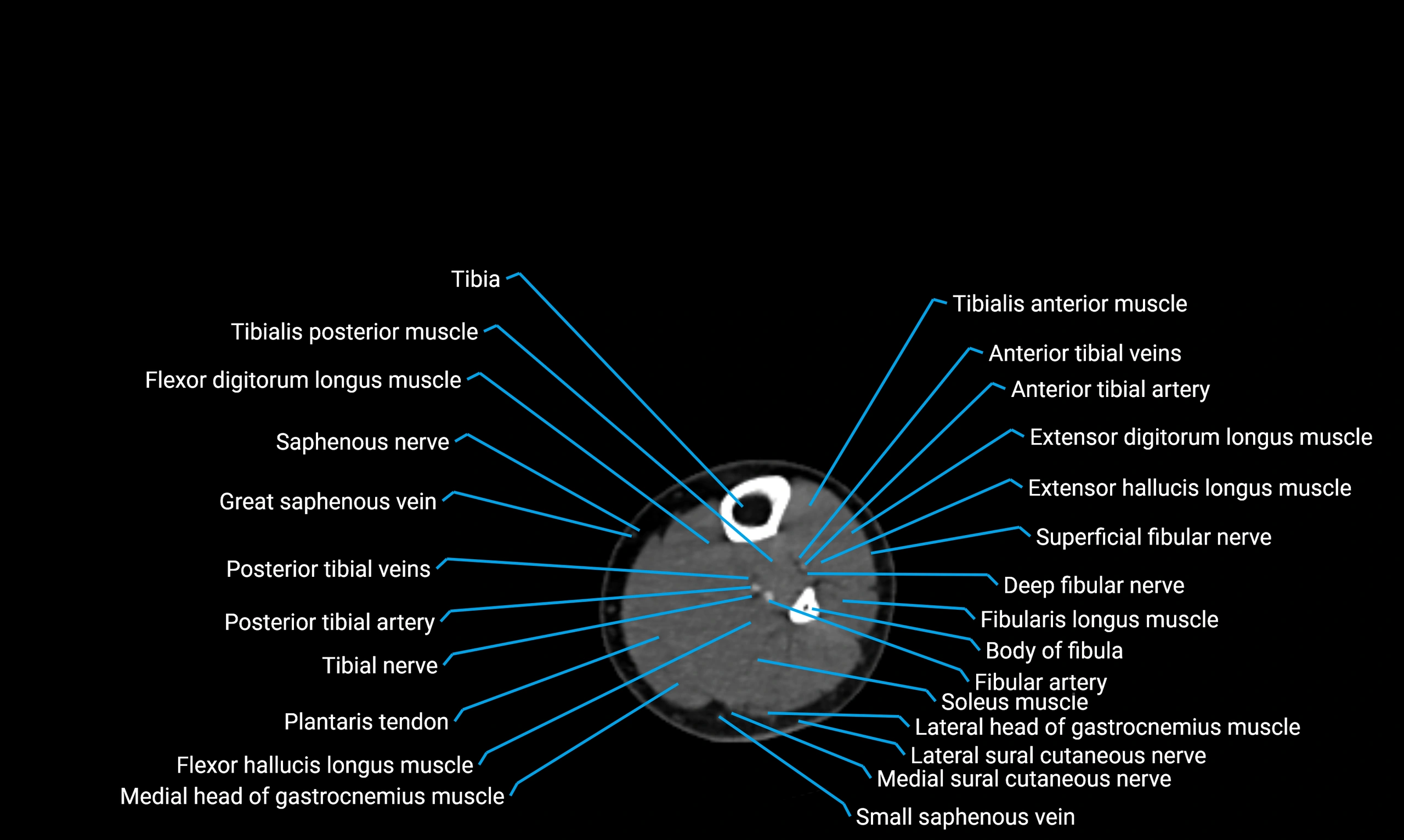 CT lower limb axial cross sectional anatomy labelled image 116 (2).webp